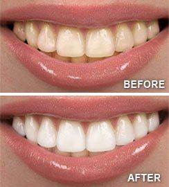 Before and after teeth whitening — Wyoming, MI — Dental South Before and after teeth whitening — Wyoming, MI — Dental South