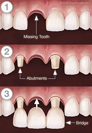 Creating a Bridge — Wyoming, MI — Dental South Creating a Bridge — Wyoming, MI — Dental South