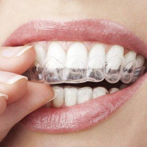 Clear aligner — Wyoming, MI — Dental South Clear aligner — Wyoming, MI — Dental South
