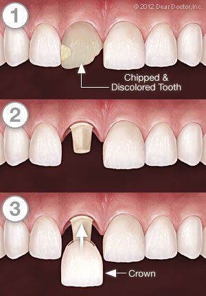 Crowning procedure — Wyoming, MI — Dental South Crowning procedure — Wyoming, MI — Dental South