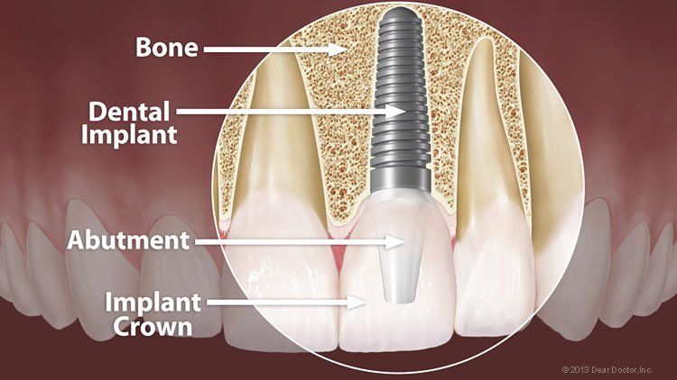 Dental Implant — Wyoming, MI — Dental South Dental Implant — Wyoming, MI — Dental South
