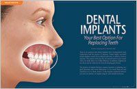 Your best option for replacing teeth — Wyoming, MI — Dental South Your best option for replacing teeth — Wyoming, MI — Dental South