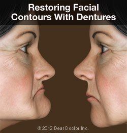 Restoring facial contours with dentures — Wyoming, MI — Dental South