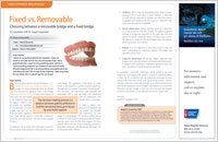 Fixed vs removable bridgework article — Wyoming, MI — Dental South Fixed vs removable bridgework article — Wyoming, MI — Dental South