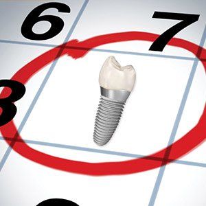 Tooth for implant — Wyoming, MI — Dental South Tooth for implant — Wyoming, MI — Dental South