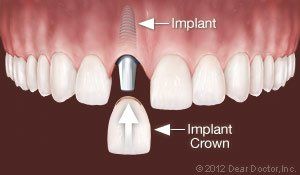 Replacing one tooth — Wyoming, MI — Dental South