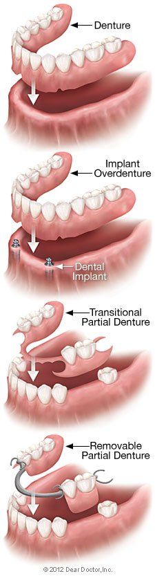 Type of full dentures — Wyoming, MI — Dental South Type of full dentures — Wyoming, MI — Dental South