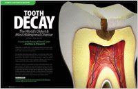 Tooth decay article — Wyoming, MI — Dental South Tooth decay article — Wyoming, MI — Dental South