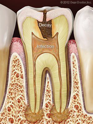 Tooth decay infection — Wyoming, MI — Dental South Tooth decay infection — Wyoming, MI — Dental South