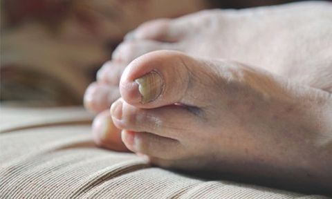 Feet treatments