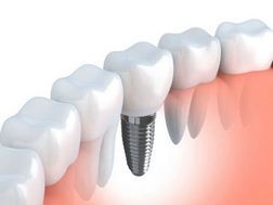 Dental Implants — Family Dental Practice in Fairless Hills, PN