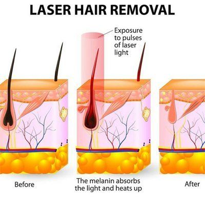 laser hair removal