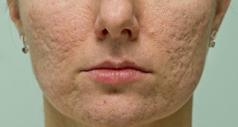 Acne treatment