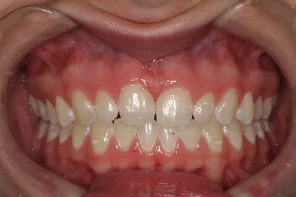 Close-up of teeth and gums inside a mouth, showing healthy, white teeth.