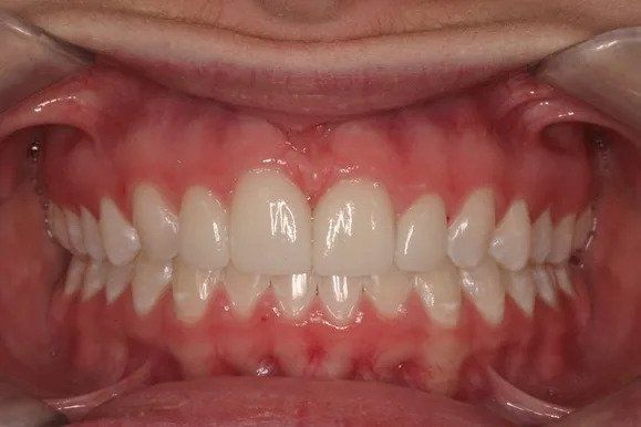 Close-up of a person's teeth. White, aligned teeth and pink gums are visible.