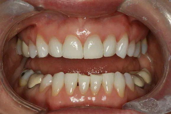 Mouth open, showing upper and lower teeth. White, even teeth set against pink gums, under a cheek retractor.
