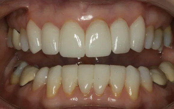 Close-up of human teeth, showing a full set with a bright, white upper row and a lower row with some yellowing.