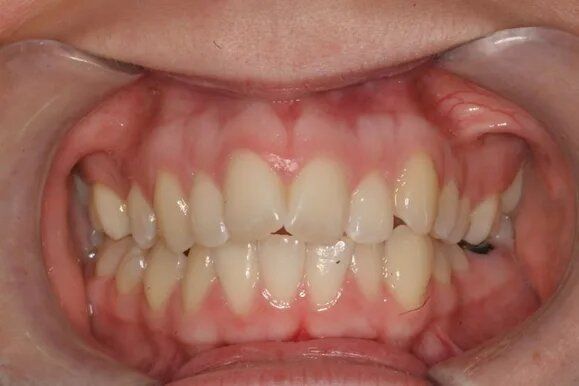 Close-up of a person's teeth. Shows a mouth with light-colored teeth, pink gums, and a lip retractor in place.