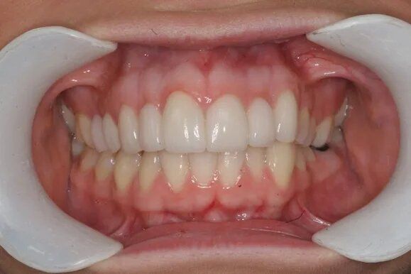 Close-up of a person's mouth with a teeth retractor. The teeth are white and aligned. Gums are pink.