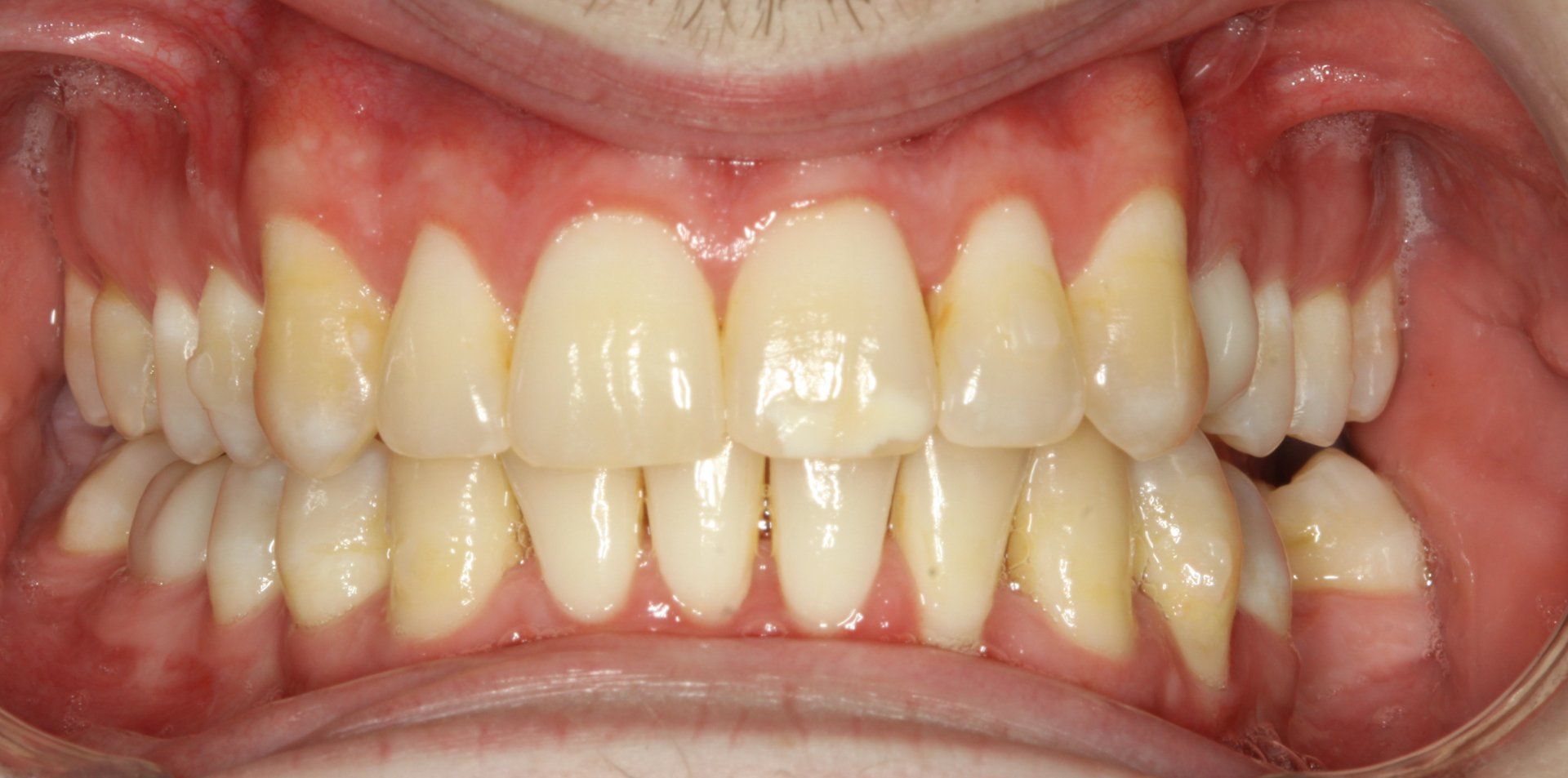 Close-up of human teeth, showing a full set with some yellowing and slight crowding. Pink gums are visible.