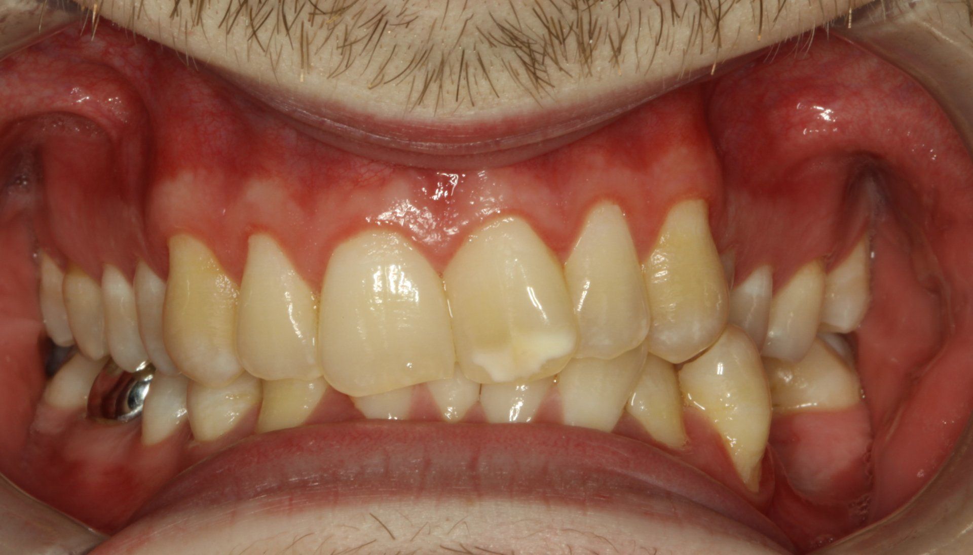 Close-up of teeth with yellowish color; gums appear inflamed. A dental implant is visible on the left side.