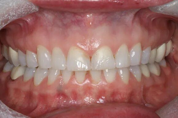 Close-up of a person's mouth with a full set of white teeth. Pink gums visible.