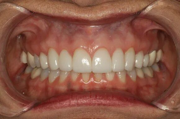 Close-up of a person's open mouth, showing healthy, white teeth and pink gums.