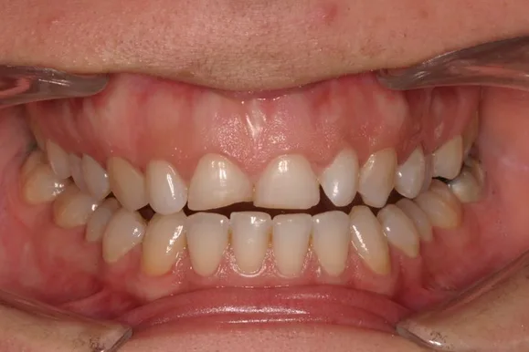 Mouth with slightly misaligned teeth, showing gums and upper and lower rows of teeth.