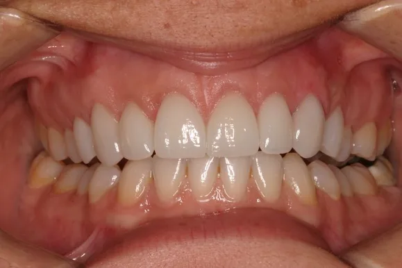 Close-up of a person's teeth. Bright, white teeth in aligned rows against pink gums.