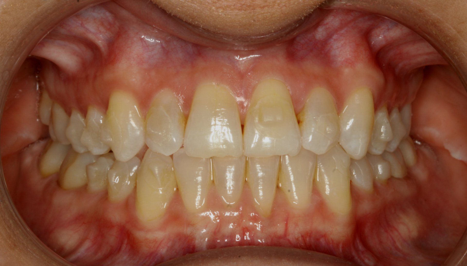 Close-up of teeth and gums. The teeth are yellow and aligned. The gums are pink and healthy.