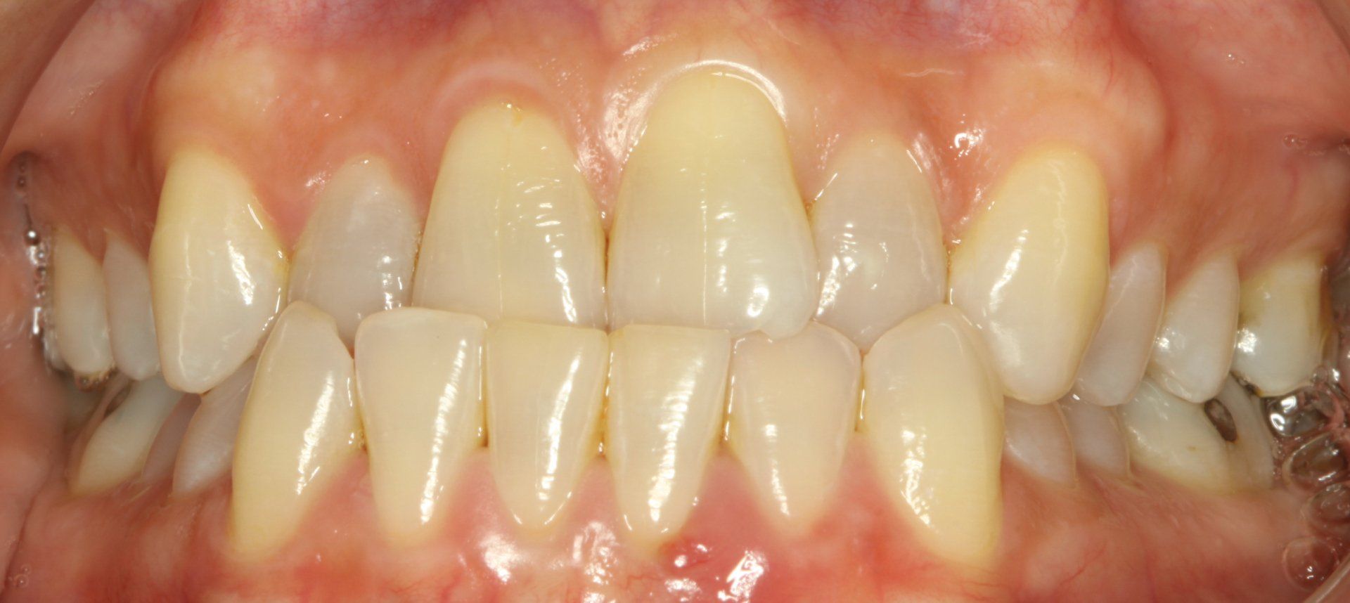 Close-up of human teeth, showing a full set with slight yellowing and gum line.