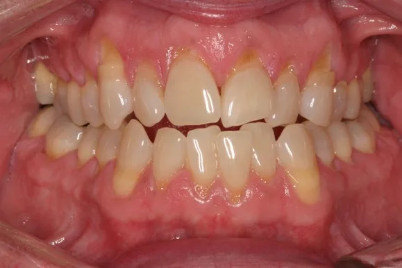 Close-up of a person's teeth. The teeth show yellowing and slight misalignment. Gums are visible and slightly inflamed.