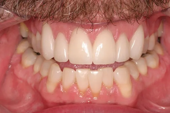 Close-up of a person's mouth with a full set of teeth, some appearing to be dental work.