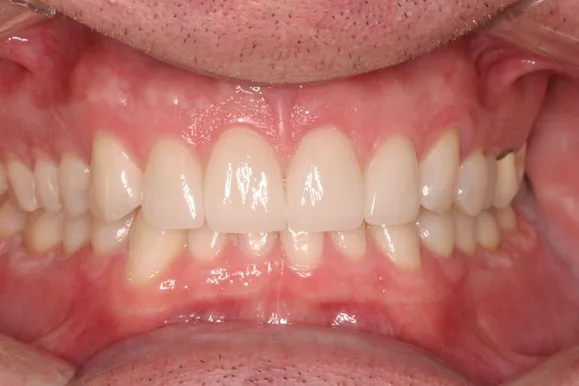 Close-up of a person's mouth showing teeth, gums, and tongue; healthy gums, white teeth.