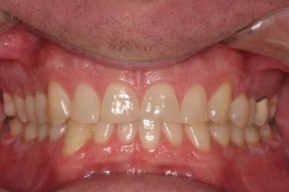 Close-up of a person's teeth. Shows a complete set of white teeth with pink gums and some surrounding skin.