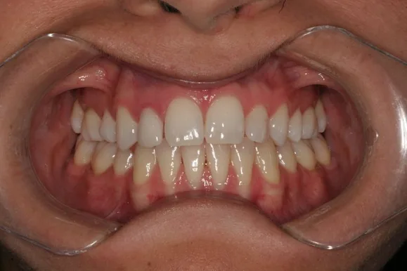 Mouth with evenly aligned, white teeth, held open by a retractor; pink gums visible.