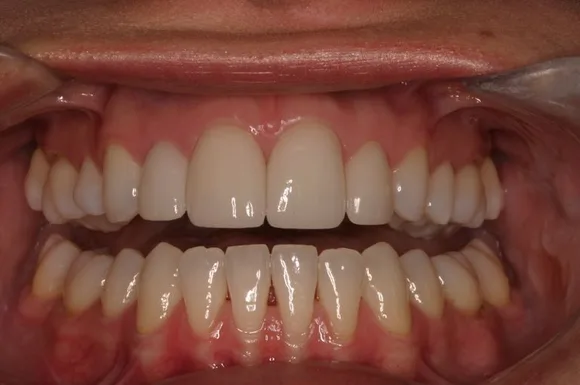 Close-up of a person's mouth displaying straight, white teeth. Pink gums are visible.