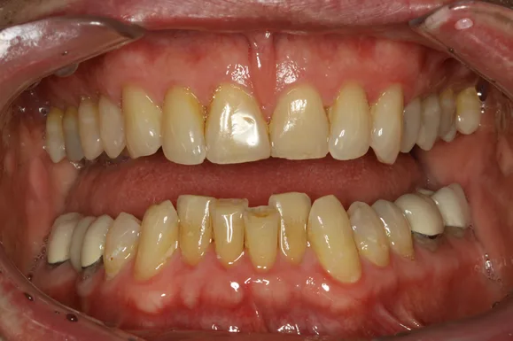 Mouth with visible upper and lower teeth, some yellowed. Central incisor chipped. Tongue visible.