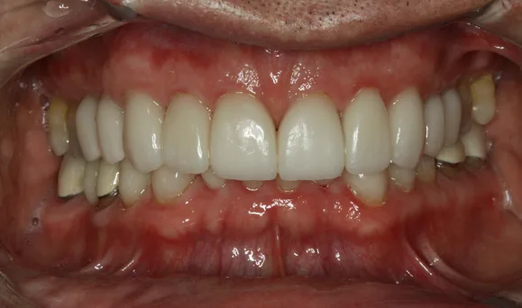 Close-up of human teeth, showing a full set with a mix of natural and possibly cosmetic enhancements.