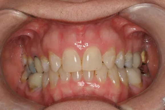 Mouth with teeth, gums visible. Several teeth appear discolored; some have fillings.