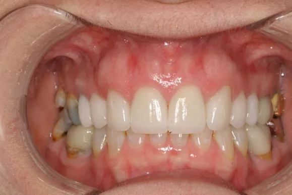 Mouth with visible teeth and gums, showing discolored fillings and white teeth.