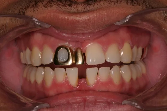 Close-up of a person's teeth, with two gold caps on front teeth. Mouth is open, showing the gums and remaining teeth.
