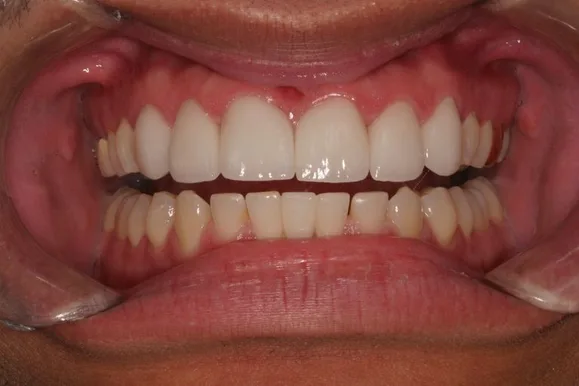 Close-up of a person's mouth with visible teeth. The upper teeth are very white; the lower teeth are slightly yellow.