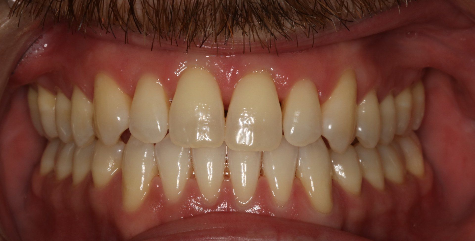 Close-up of a person's teeth, showing a full set with a slight yellow tint. The gums are pink.