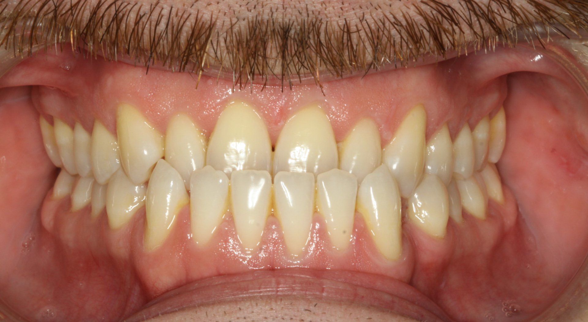 Close-up of human teeth, showing a full set in a natural, open-mouthed view. Teeth are off-white with healthy gums.
