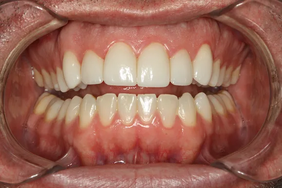 Mouth with teeth, showing upper and lower rows. Some teeth are whiter and slightly larger than others.