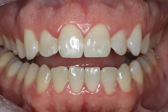 Close-up of a person's teeth. White teeth, pink gums, open mouth, natural light.