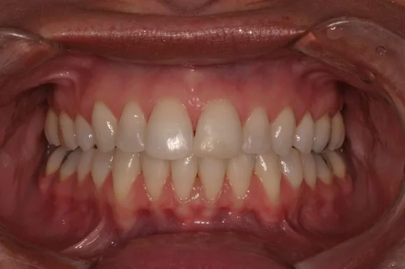Close-up of a person's open mouth, showing healthy teeth and gums; pink gums, white teeth.