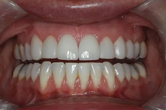 Close-up of a person's teeth. They are white and evenly spaced. Gums are pink.
