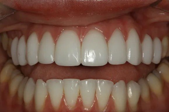 Close-up of a mouth with bright white teeth; upper and lower rows are visible.